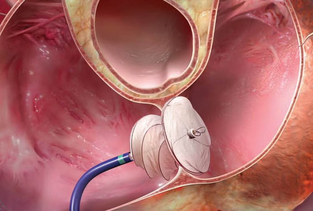 graphic of helex septal occluder